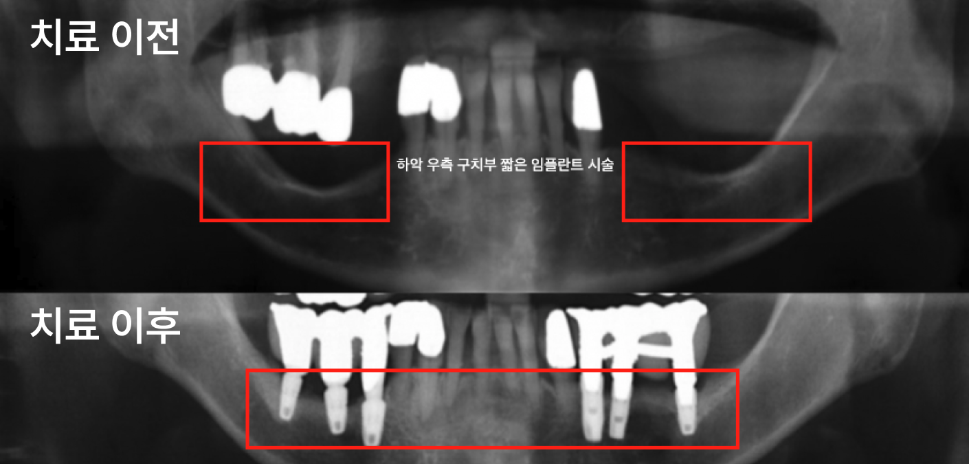 어금니 임플란트