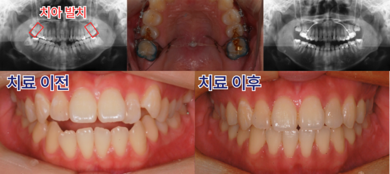 앞니 교정