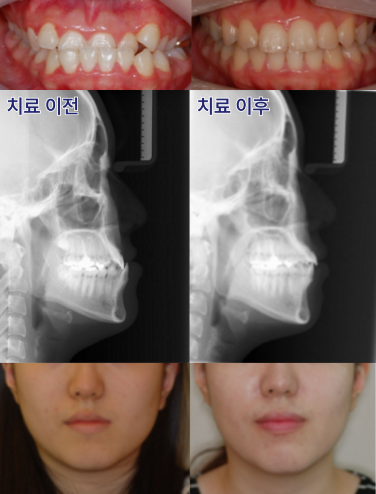 안면비대칭 치아교정