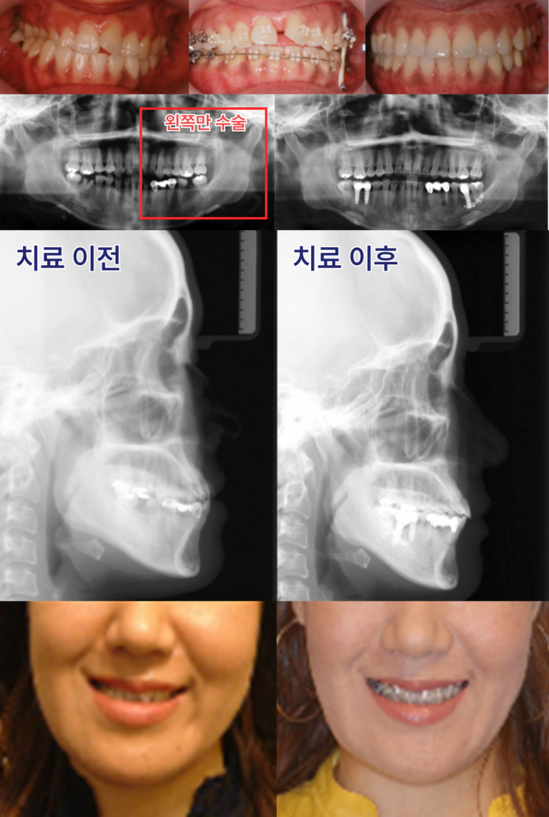 턱교정